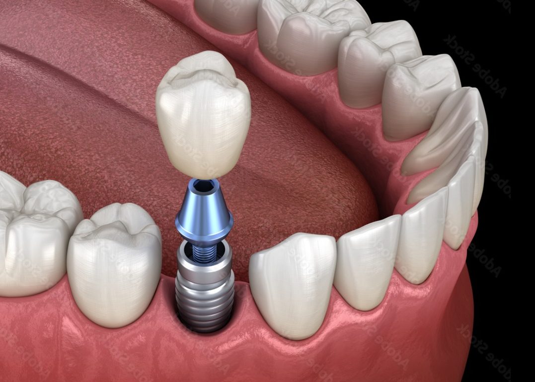 Implants Eastbourne Gentle Dental