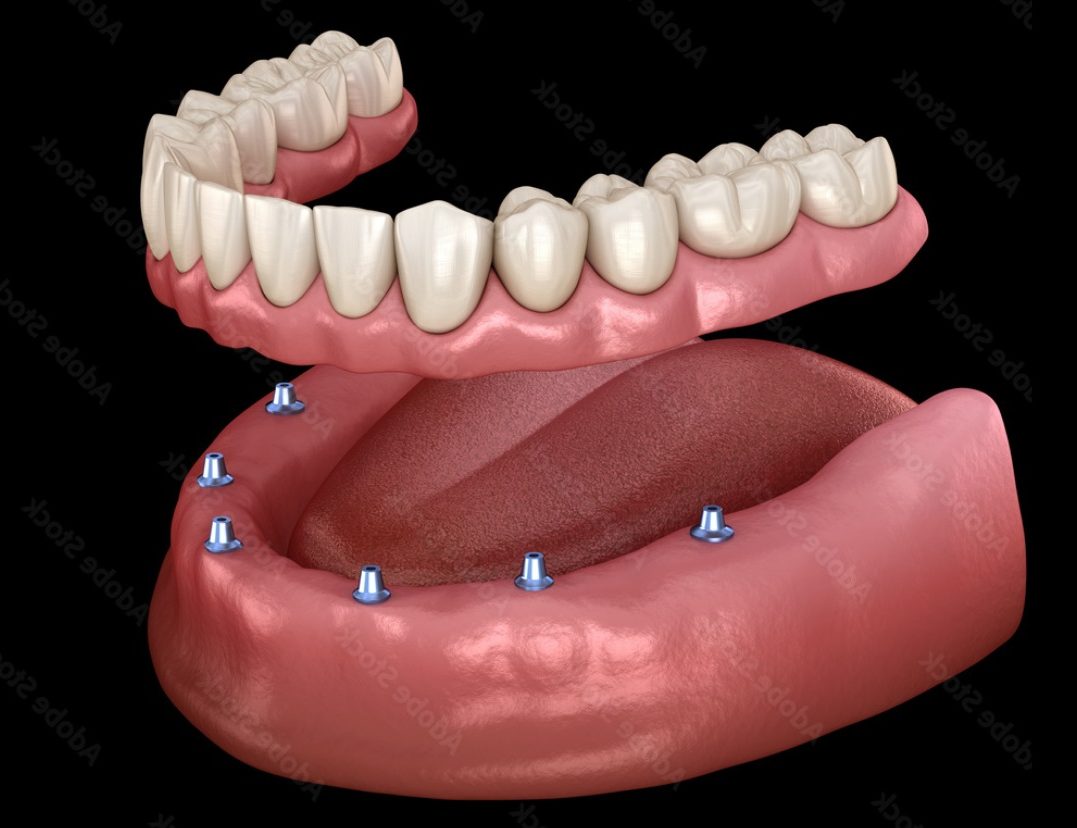 Implants Eastbourne Gentle Dental