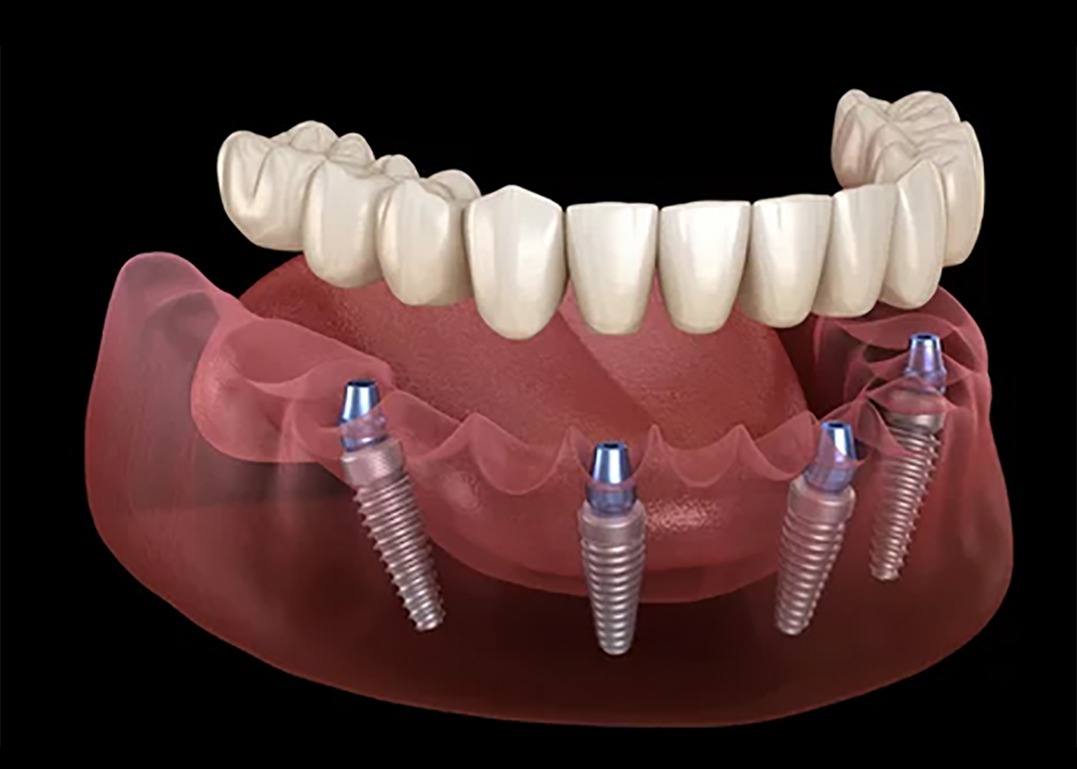 Implants Eastbourne Gentle Dental