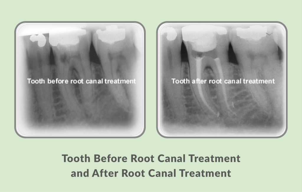 Tooth Before and After Root Canal Treatment