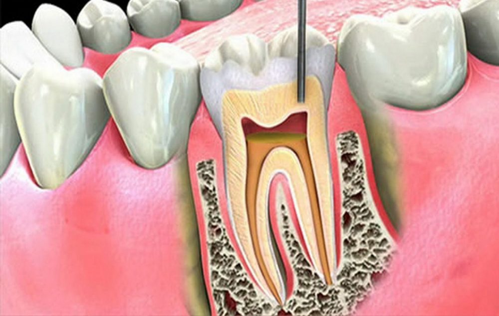 Endodontics